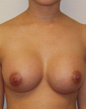 Breast Augmentation Saline Implants Before and After | CIARAVINO Plastic Surgery