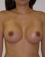 Breast Augmentation Saline Implants Before and After | CIARAVINO Plastic Surgery