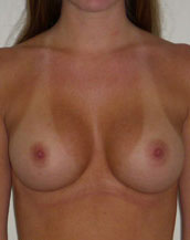 Breast Augmentation Saline Implants Before and After | CIARAVINO Plastic Surgery