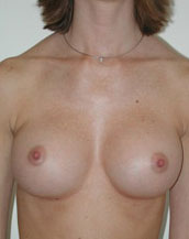 Breast Augmentation Saline Implants Before and After | CIARAVINO Plastic Surgery