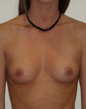 Breast Augmentation Saline Implants Before and After | CIARAVINO Plastic Surgery