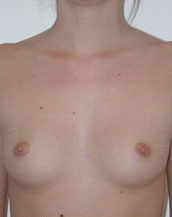 Breast Augmentation Saline Implants Before and After | CIARAVINO Plastic Surgery