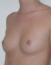 Breast Augmentation Saline Implants Before and After | CIARAVINO Plastic Surgery