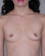 Breast Augmentation Saline Implants Before and After | CIARAVINO Plastic Surgery