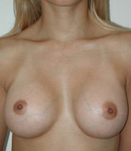 Breast Augmentation Saline Implants Before and After | CIARAVINO Plastic Surgery