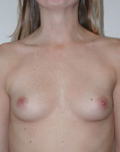 Breast Augmentation Saline Implants Before and After | CIARAVINO Plastic Surgery