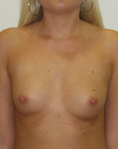 Breast Augmentation Saline Implants Before and After | CIARAVINO Plastic Surgery