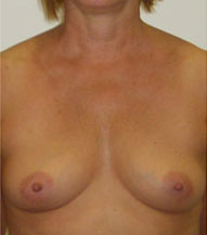 Breast Augmentation Saline Implants Before and After | CIARAVINO Plastic Surgery