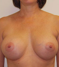 Breast Augmentation Saline Implants Before and After | CIARAVINO Plastic Surgery