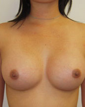 Breast Augmentation Saline Implants Before and After | CIARAVINO Plastic Surgery