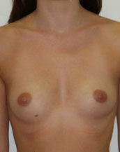 Breast Augmentation Saline Implants Before and After | CIARAVINO Plastic Surgery