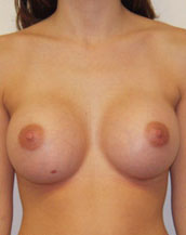 Breast Augmentation Saline Implants Before and After | CIARAVINO Plastic Surgery