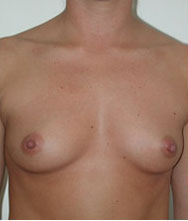 Breast Augmentation Saline Implants Before and After | CIARAVINO Plastic Surgery