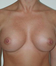 Breast Augmentation Saline Implants Before and After | CIARAVINO Plastic Surgery