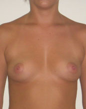Breast Augmentation Saline Implants Before and After | CIARAVINO Plastic Surgery