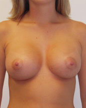 Breast Augmentation Saline Implants Before and After | CIARAVINO Plastic Surgery