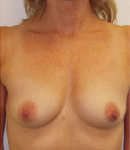 Breast Augmentation Saline Implants Before and After | CIARAVINO Plastic Surgery