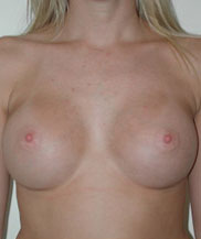 Breast Augmentation Saline Implants Before and After | CIARAVINO Plastic Surgery