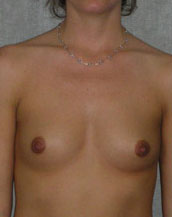 Breast Augmentation Saline Implants Before and After | CIARAVINO Plastic Surgery