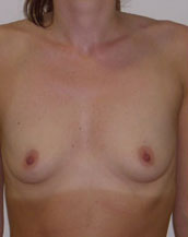 Breast Augmentation Saline Implants Before and After | CIARAVINO Plastic Surgery