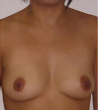 Breast Augmentation Saline Implants Before and After | CIARAVINO Plastic Surgery