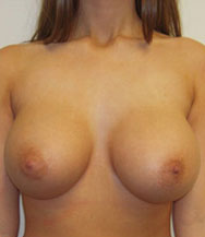 Breast Augmentation Saline Implants Before and After | CIARAVINO Plastic Surgery