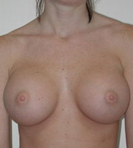 Breast Augmentation Saline Implants Before and After | CIARAVINO Plastic Surgery