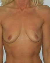 Breast Augmentation Saline Implants Before and After | CIARAVINO Plastic Surgery