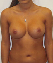 Breast Augmentation Saline Implants Before and After | CIARAVINO Plastic Surgery