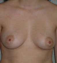 Breast Augmentation Saline Implants Before and After | CIARAVINO Plastic Surgery