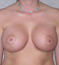 Breast Augmentation Saline Implants Before and After | CIARAVINO Plastic Surgery