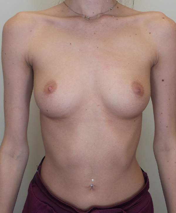 Breast Augmentation Saline Implants Before and After | CIARAVINO Plastic Surgery