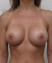 Saline Breast Implants Houston