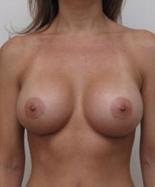 Silicone Breast Implants Houston