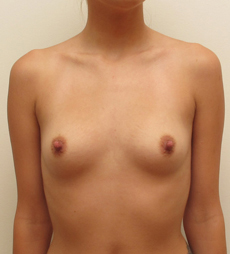 Houston Breast Augmentation