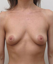 Breast Augmentation Silicone Implants Before and After | CIARAVINO Plastic Surgery