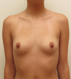 Breast Augmentation Silicone Implants Before and After | CIARAVINO Plastic Surgery