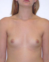 Breast Augmentation Silicone Implants Before and After | CIARAVINO Plastic Surgery