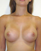 Breast Augmentation Silicone Implants Before and After | CIARAVINO Plastic Surgery