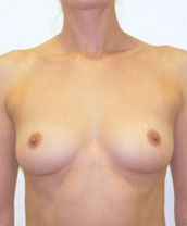 Breast Augmentation Silicone Implants Before and After | CIARAVINO Plastic Surgery