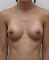 Breast Augmentation Silicone Implants Before and After | CIARAVINO Plastic Surgery