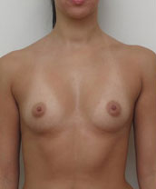 Breast Augmentation Silicone Implants Before and After | CIARAVINO Plastic Surgery