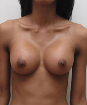 Breast Augmentation Silicone Implants Before and After | CIARAVINO Plastic Surgery