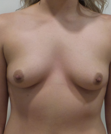 Breast Augmentation Silicone Implants Before and After | CIARAVINO Plastic Surgery