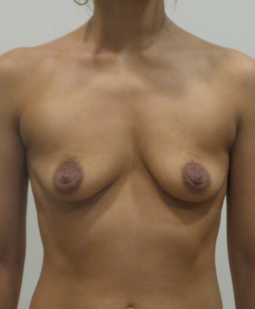 Breast Augmentation Silicone Implants Before and After | CIARAVINO Plastic Surgery