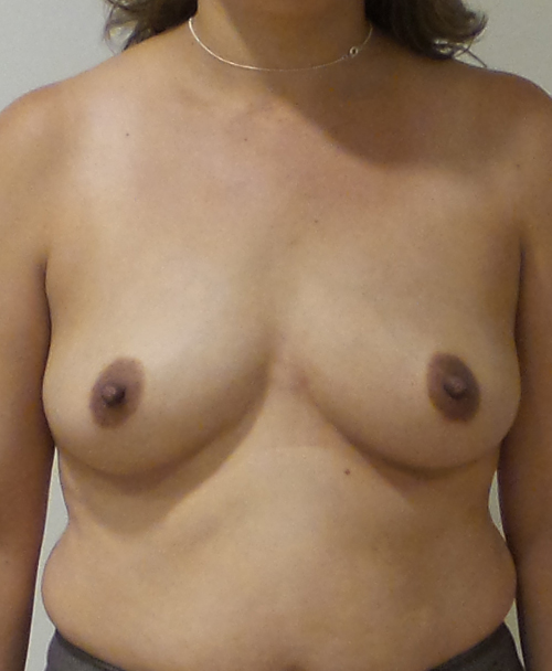 Breast Augmentation Silicone Implants Before and After | CIARAVINO Plastic Surgery