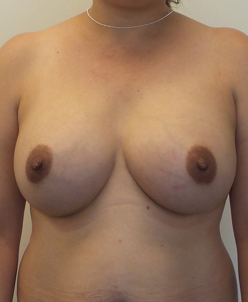 Breast Augmentation Silicone Implants Before and After | CIARAVINO Plastic Surgery