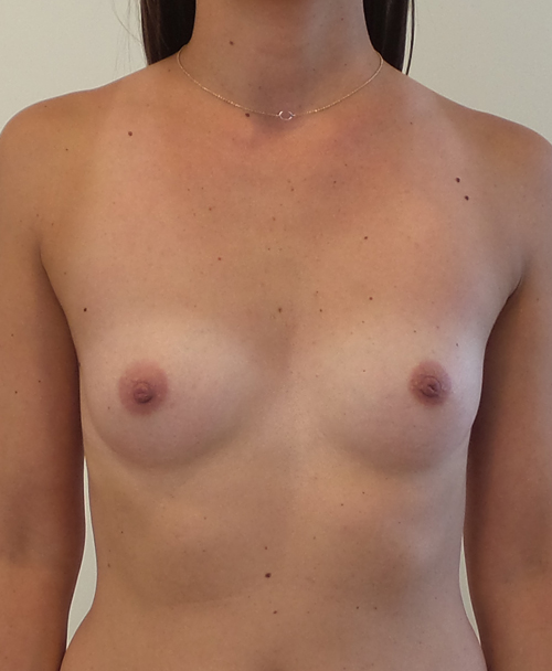 Breast Augmentation Silicone Implants Before and After | CIARAVINO Plastic Surgery