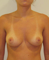 Breast Augmentation Silicone Implants Before and After | CIARAVINO Plastic Surgery