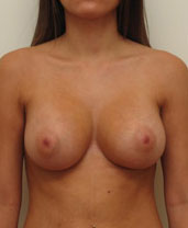 Breast Augmentation Silicone Implants Before and After | CIARAVINO Plastic Surgery